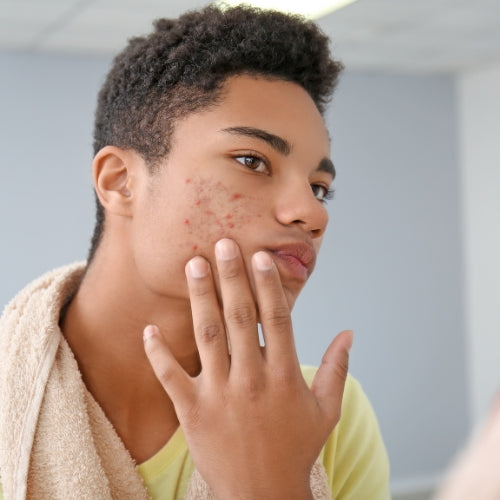 Acne Attack: Top Tips to Nuke Those Pesky Pimples
